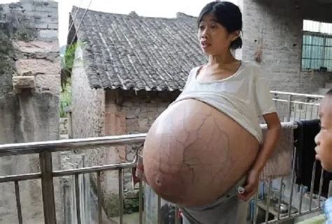 40周孕妇5胞胎巨肚变化
